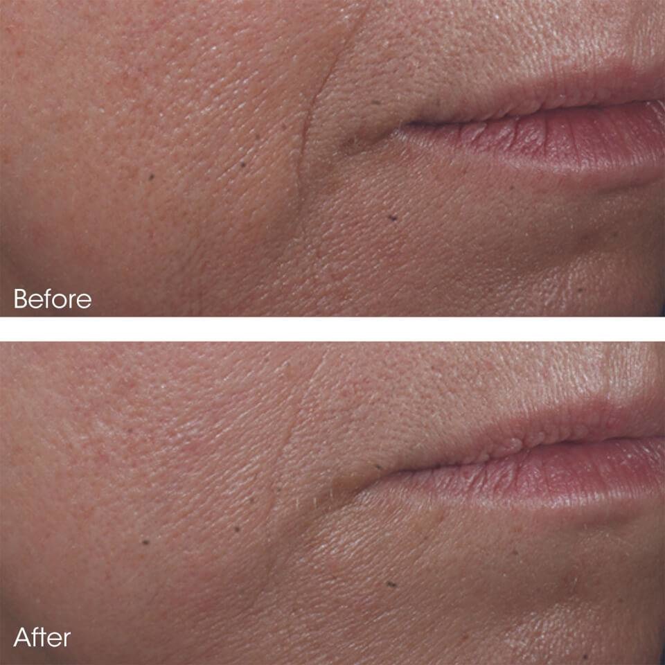 Perricone MD Cold Plasma Plus Advanced Serum Concentrate - Siero Viso 30 ml, Combatte Rughe, Pori Dilatati e Discromie